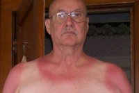 sunburn.jpg